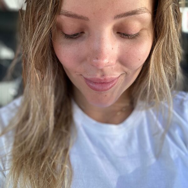 despues rinoplastia ana 1 despues rinoplastia ana 1