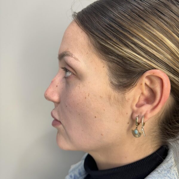 ana antes rinoplastia malaga 1 ana antes rinoplastia malaga 1
