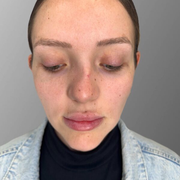 antes ana rinoplastia malaga antes ana rinoplastia malaga
