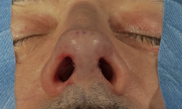 rinoplastia abierta o cerrada (2) rinoplastia abierta o cerrada (2)