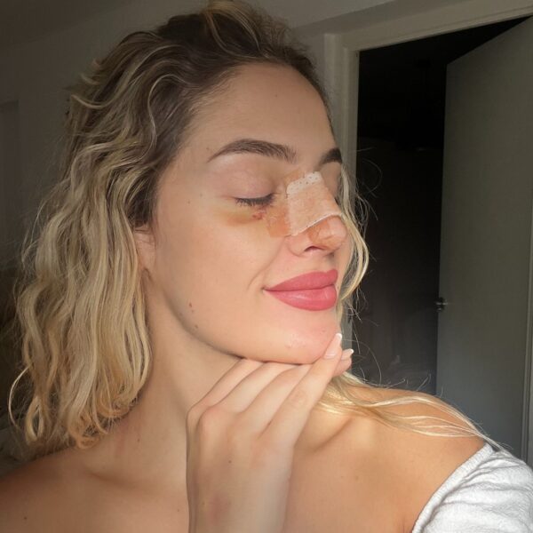 paola despues rinoplastia paola despues rinoplastia