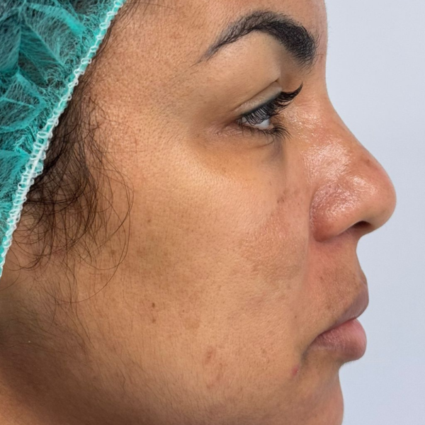 rinoplastia armonica malaga (2) rinoplastia armonica malaga (2)