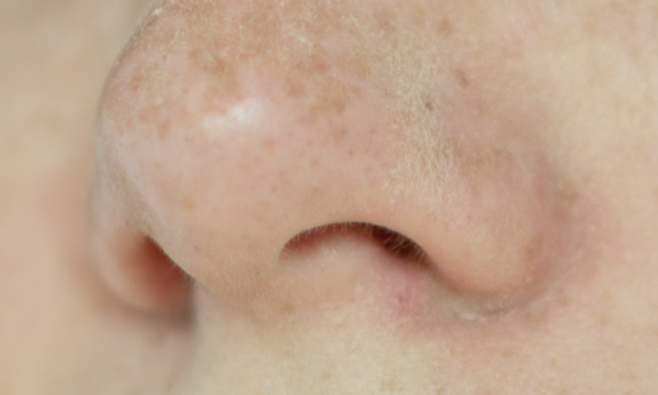 rinoplastia cerrada rinoplastia cerrada